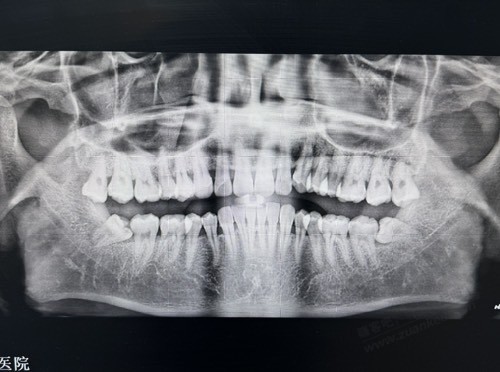 今天去拔智齿了