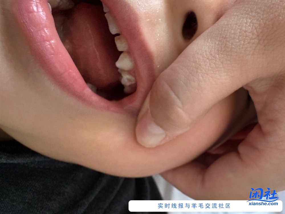 三岁半，牙齿脱矿了 ，涂氟管用吗？有啥宝宝能用氟求推推荐