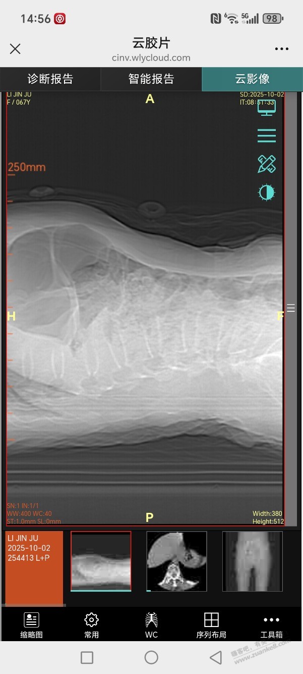 腰椎L1压缩性骨折做骨水泥手术得多少钱