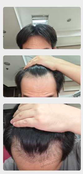 我这额角M秃还有救吗，非那加米诺？戴假发方便吗？