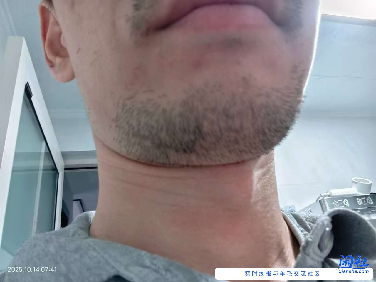 胡须太多了怎么办？