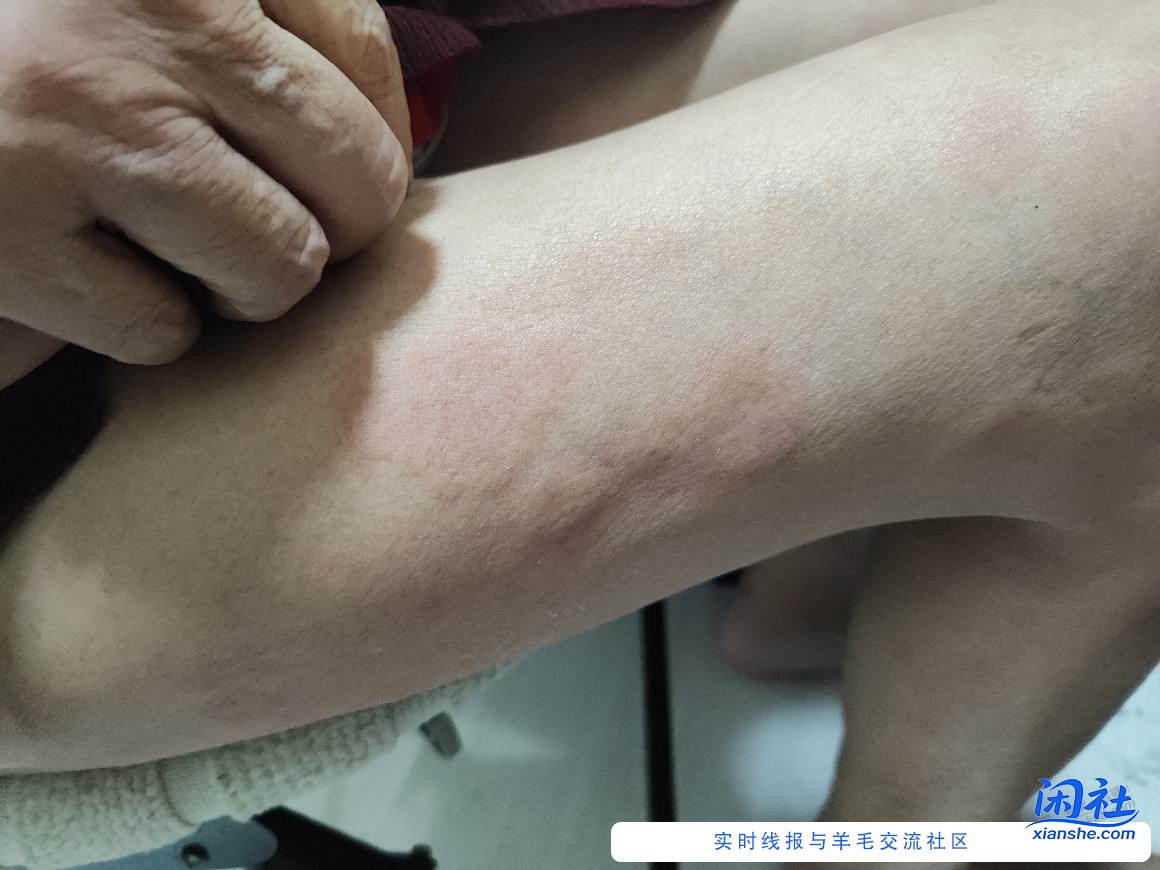 求吧医，现在浑身刺挠，密集恐惧症误进