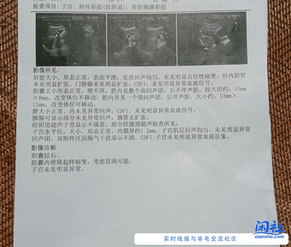 有了解结石的吧友吗