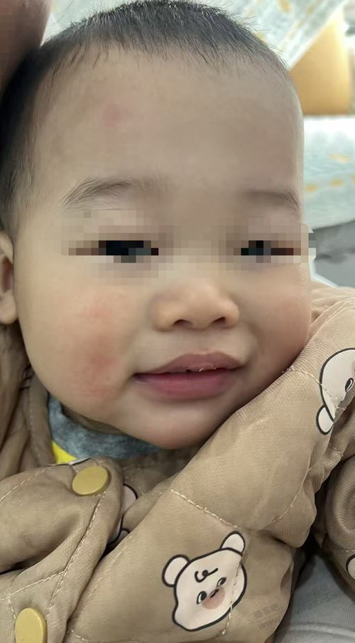 宝宝脸上起的像什么