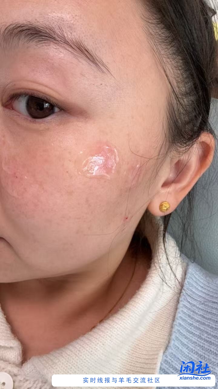 老婆想去本市三甲医院打一下雀斑,说是3600一次.总共三次1W1,每次间隔2月!不知道靠谱不