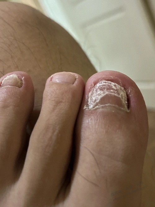 给大家推荐一个灰指甲的药吧，便宜，有用，亲测